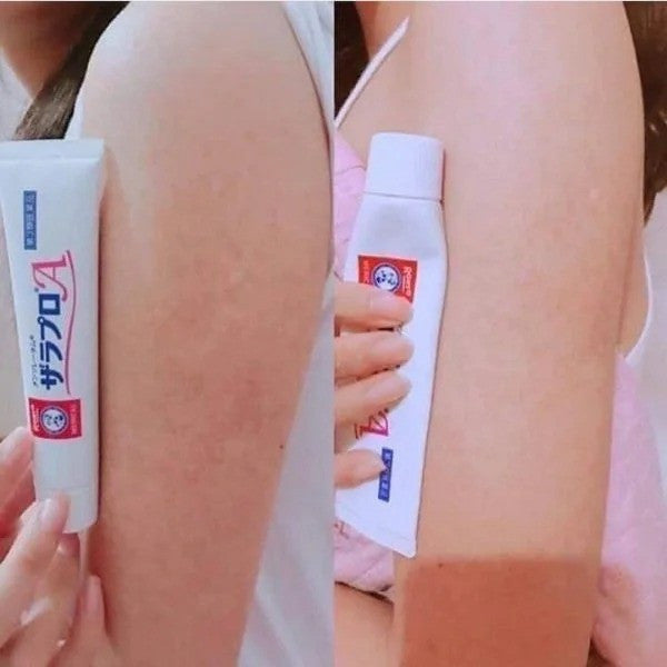Kem trị viêm nang lông Zaraporo Rohto Nhật Bản 35g