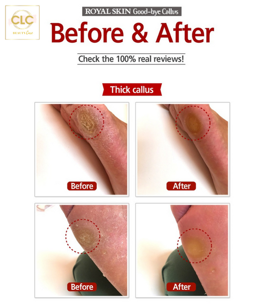 Dụng cụ tẩy tế bào chết cho chân Royal Skin Goodbye Callus (Pack of 1)